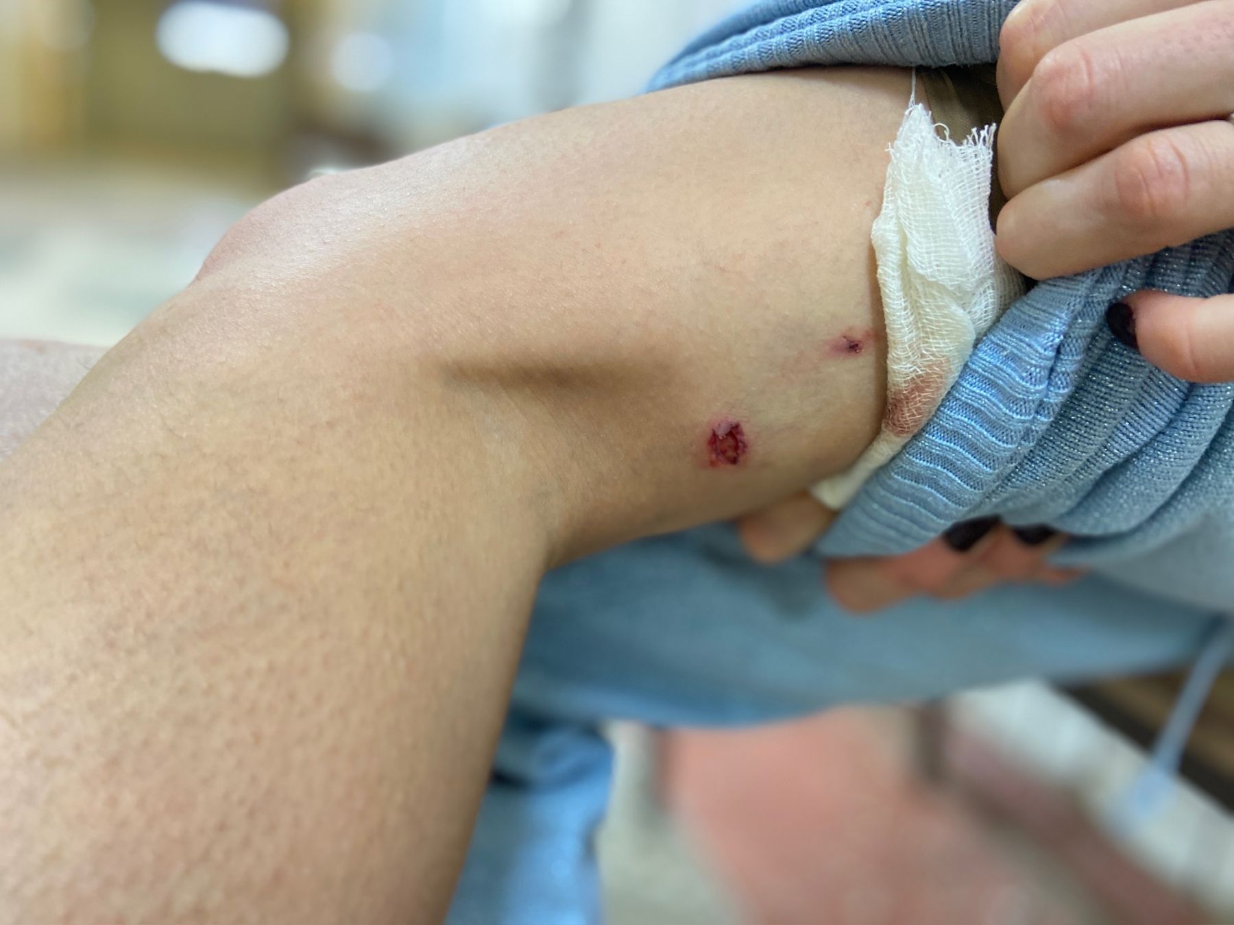 Рана. Укусила собака. Больница