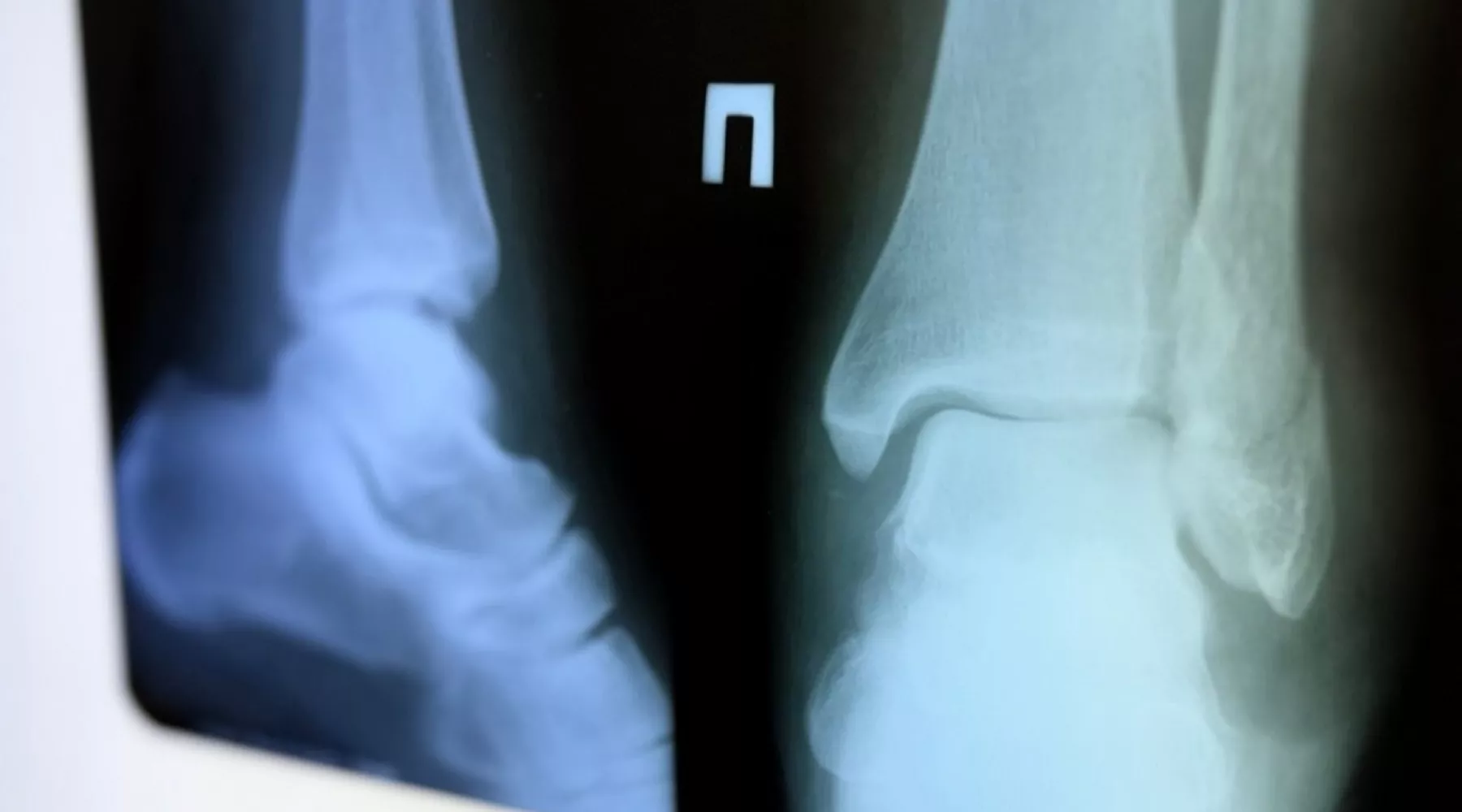 Травма. Перелом. Гололед 